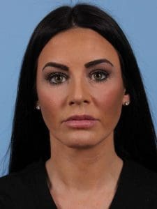 Dermal Fillers - Case 15003 - After