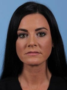 Dermal Fillers - Case 15003 - Before