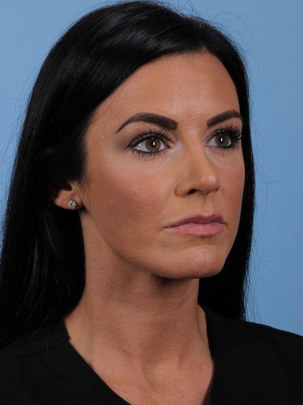 Dermal Fillers Patient Photo - Case 15003 - before view-4