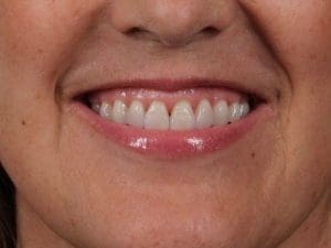 Dermal Fillers - Case 15016 - Before