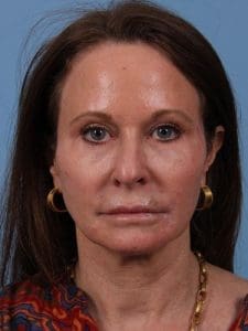 Dermal Fillers - Case 15020 - After