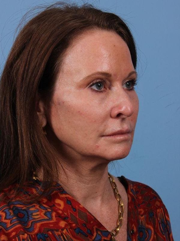 Dermal Fillers Patient Photo - Case 15020 - after view-4