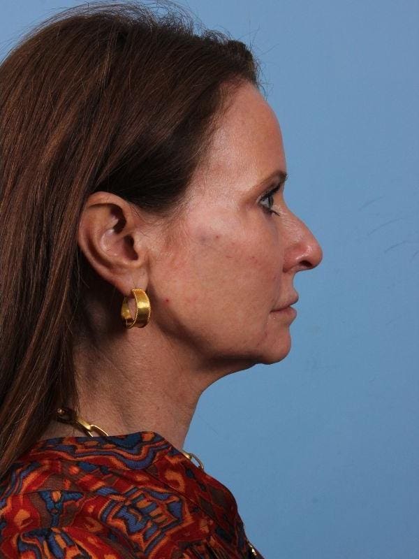 Dermal Fillers Patient Photo - Case 15020 - after view-2