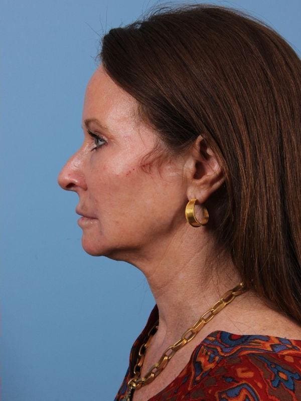 Dermal Fillers Patient Photo - Case 15020 - after view-1