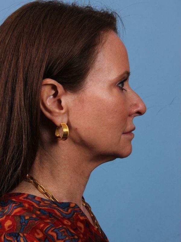 Dermal Fillers Patient Photo - Case 15020 - before view-2