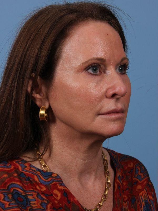 Dermal Fillers Patient Photo - Case 15020 - before view-4