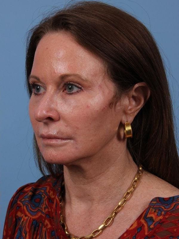Dermal Fillers Patient Photo - Case 15020 - after view-3