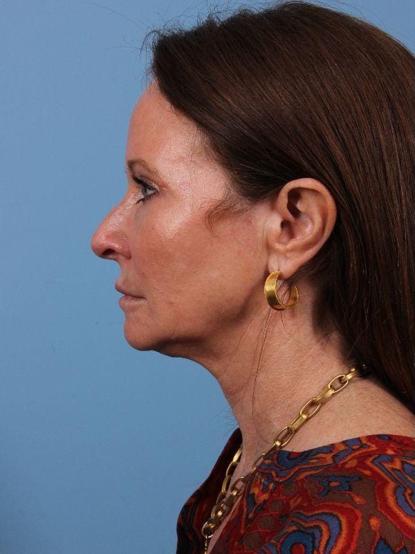 Dermal Fillers Patient Photo - Case 15020 - before view-1