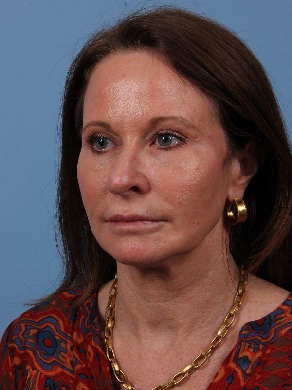 Dermal Fillers Patient Photo - Case 15020 - before view-3
