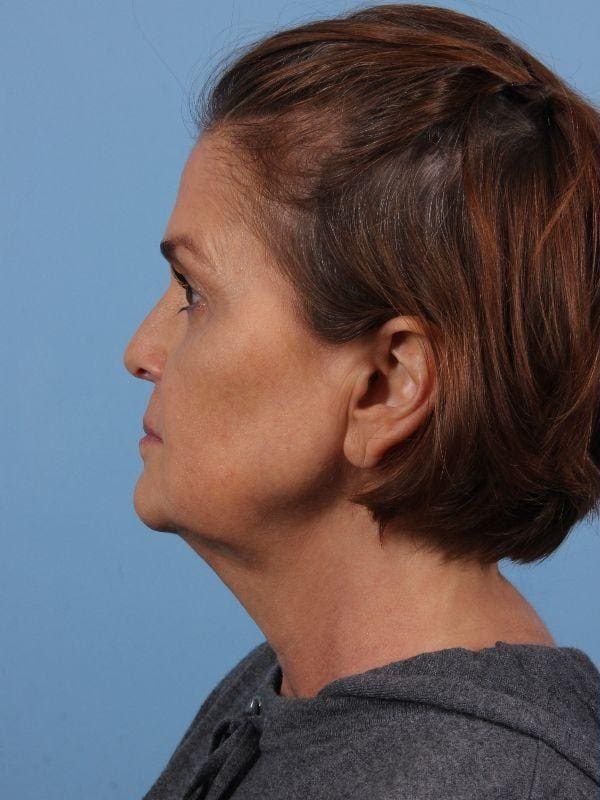 Dermal Fillers Patient Photo - Case 15032 - before view-1