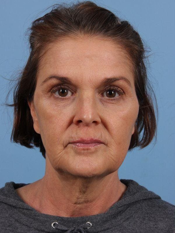 Injectable Fillers Patient Photo - Case 15032 - before view-