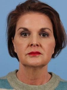 Dermal Fillers - Case 15032 - After