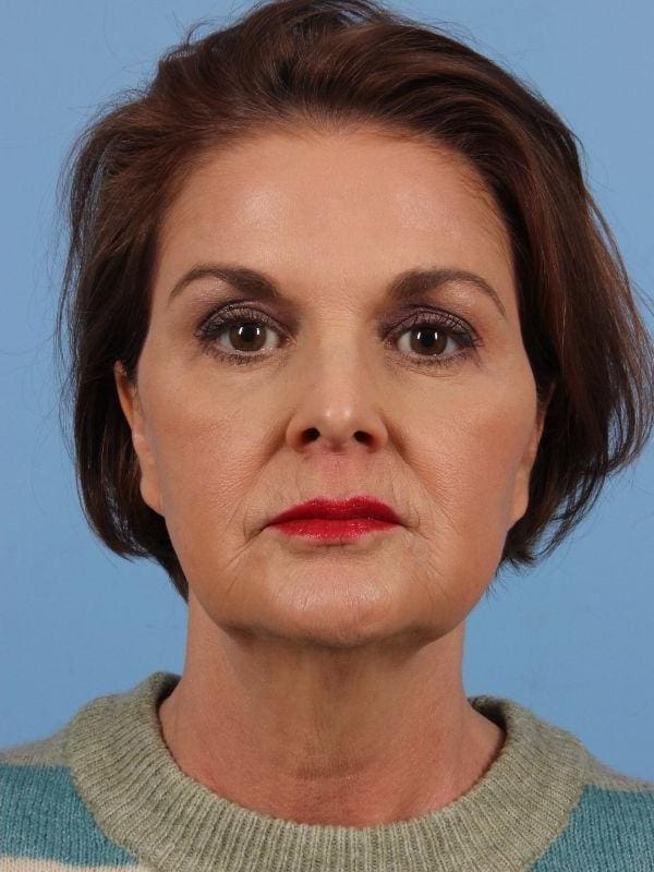 Injectable Fillers Patient Photo - Case 15032 - after view