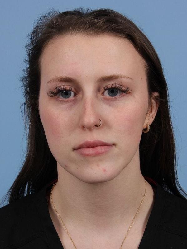 Injectable Fillers Patient Photo - Case 15044 - after view