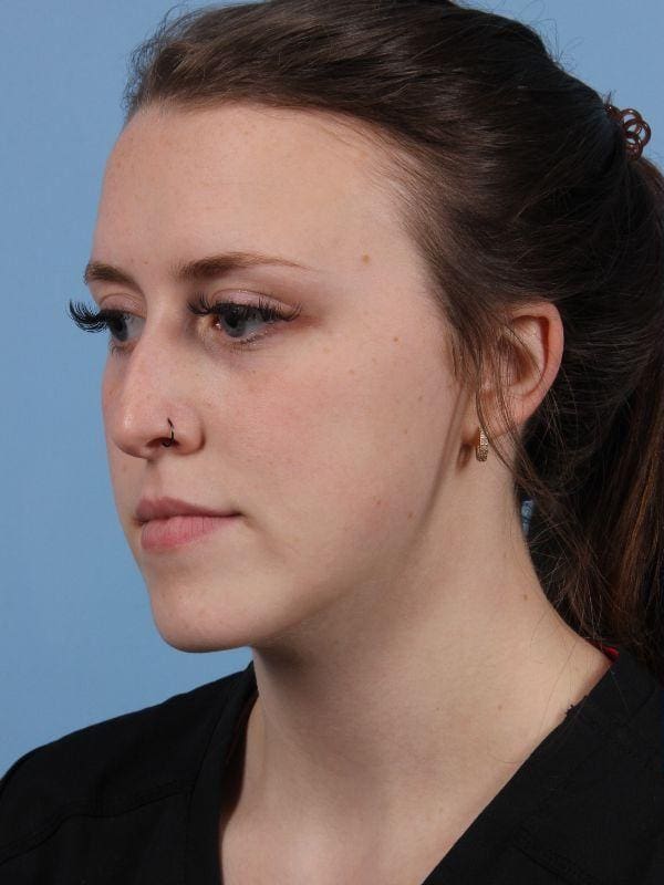 Injectable Fillers Patient Photo - Case 15044 - before view-1