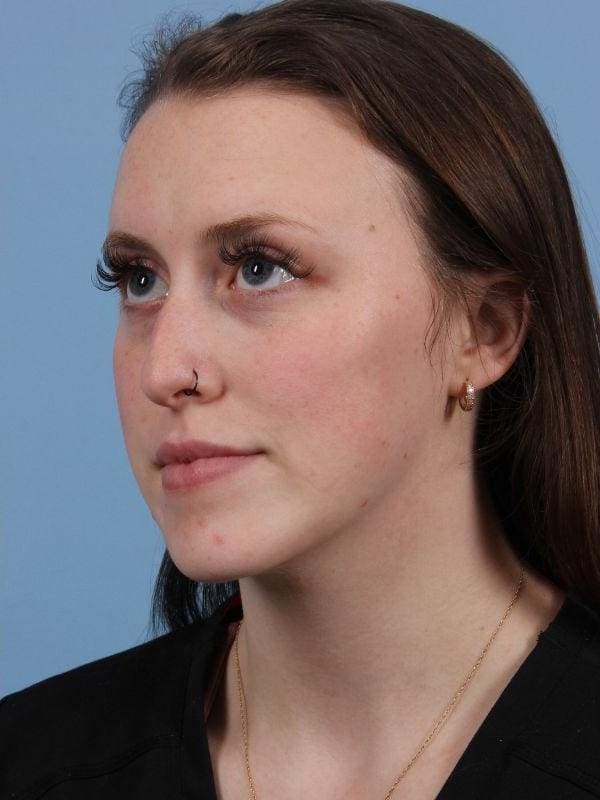 Injectable Fillers Patient Photo - Case 15044 - after view-1