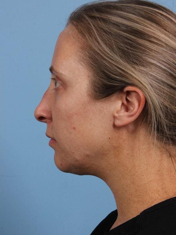 Dermal Fillers Patient Photo - Case 15051 - after view-1