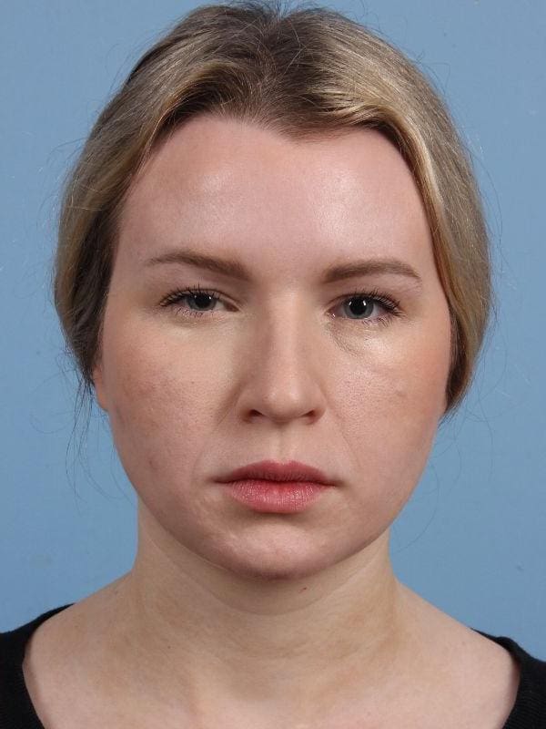 Botox Patient Photo - Case 15063 - after view-2