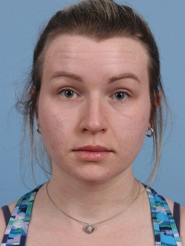 Botox Patient Photo - Case 15063 - before view-1