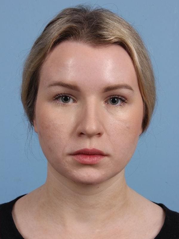 Botox Patient Photo - Case 15063 - after view