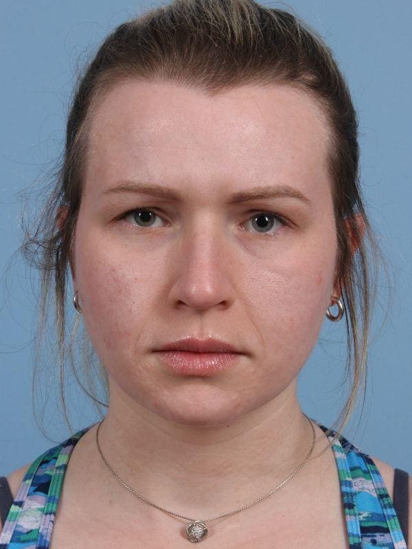 Botox Patient Photo - Case 15063 - before view-2