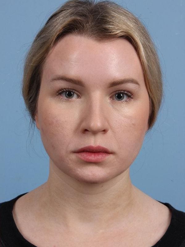 Botox Patient Photo - Case 15063 - after view-1