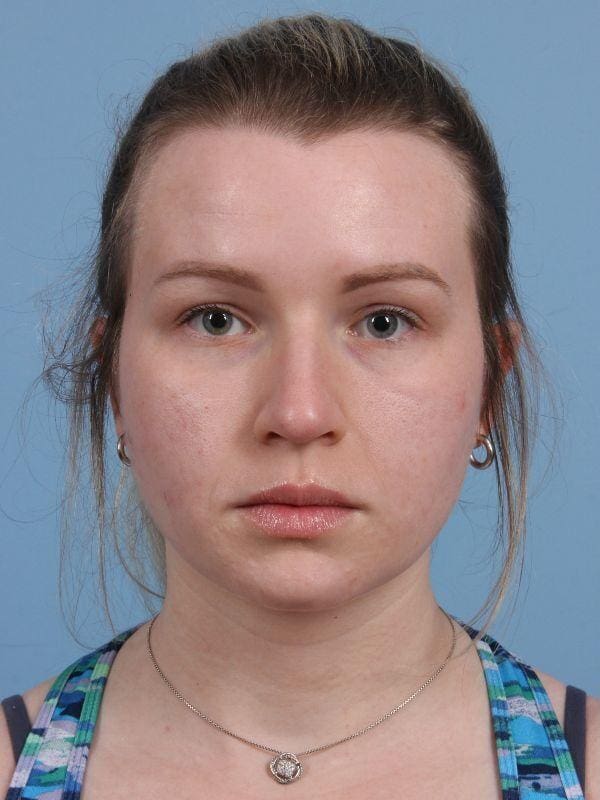 Botox Patient Photo - Case 15063 - before view-