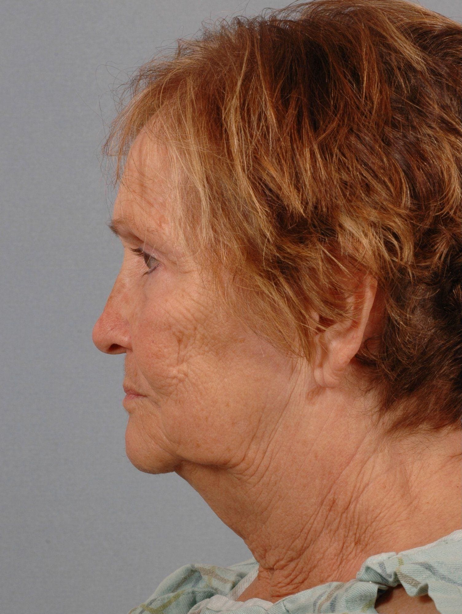 Facelift Patient Photo - Case 15078 - before view-1