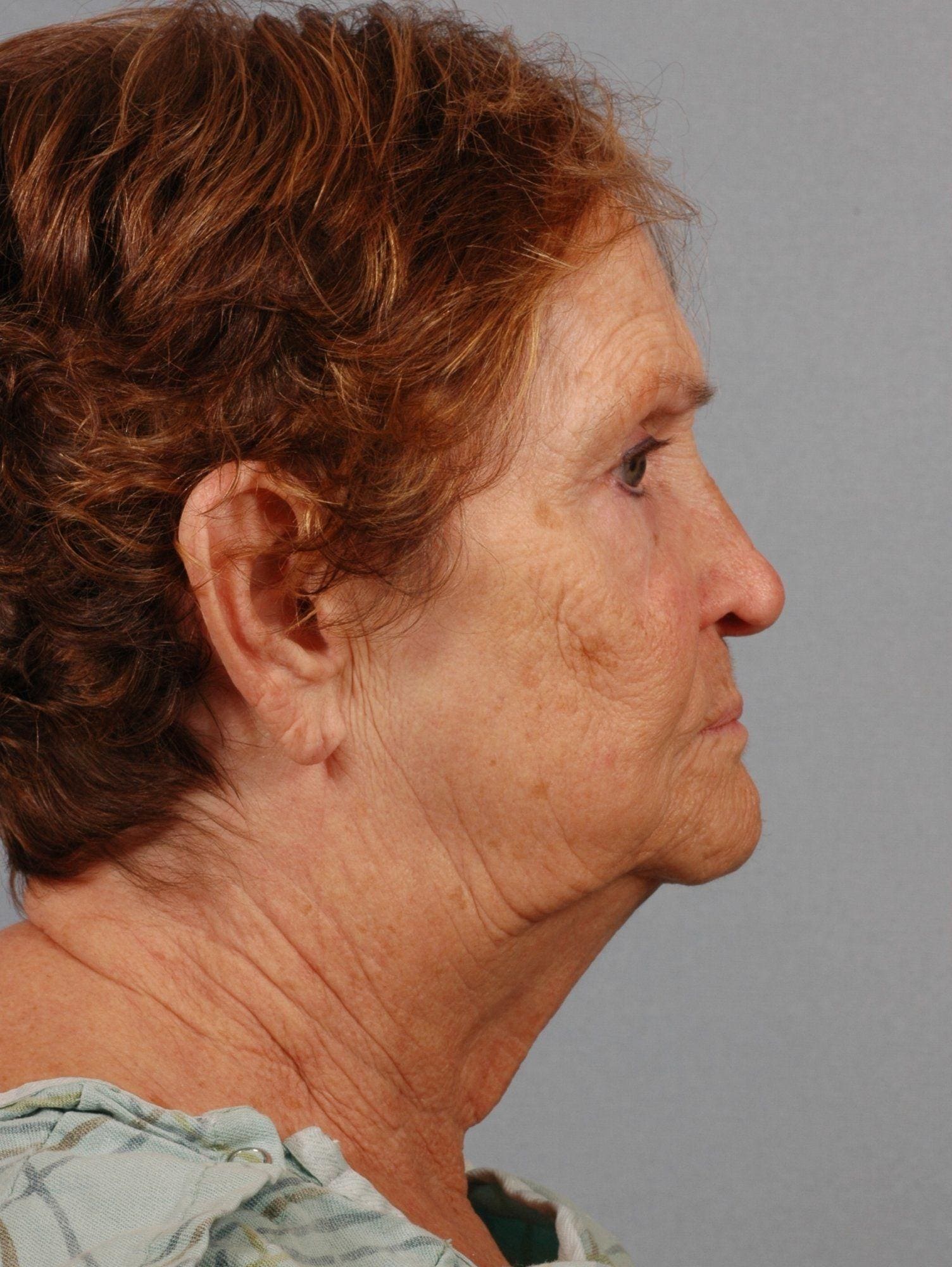 Facelift Patient Photo - Case 15078 - before view-2