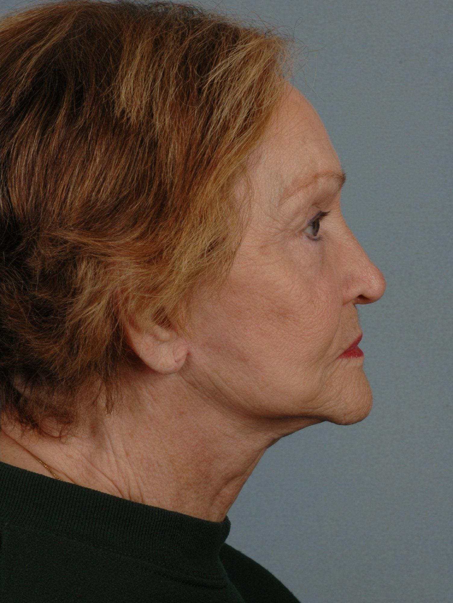 Facelift Patient Photo - Case 15078 - after view-2