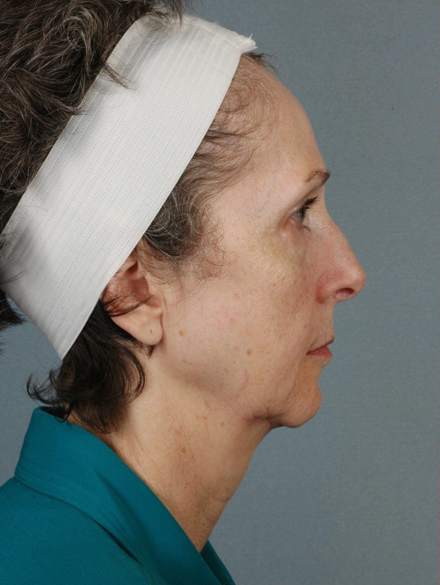 Facelift Patient Photo - Case 15090 - before view-2