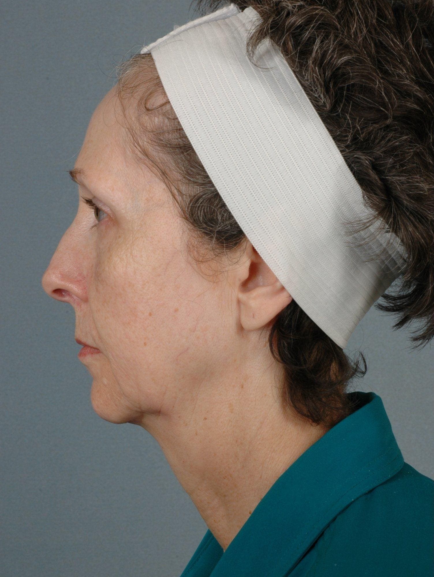 Facelift Patient Photo - Case 15090 - before view-1