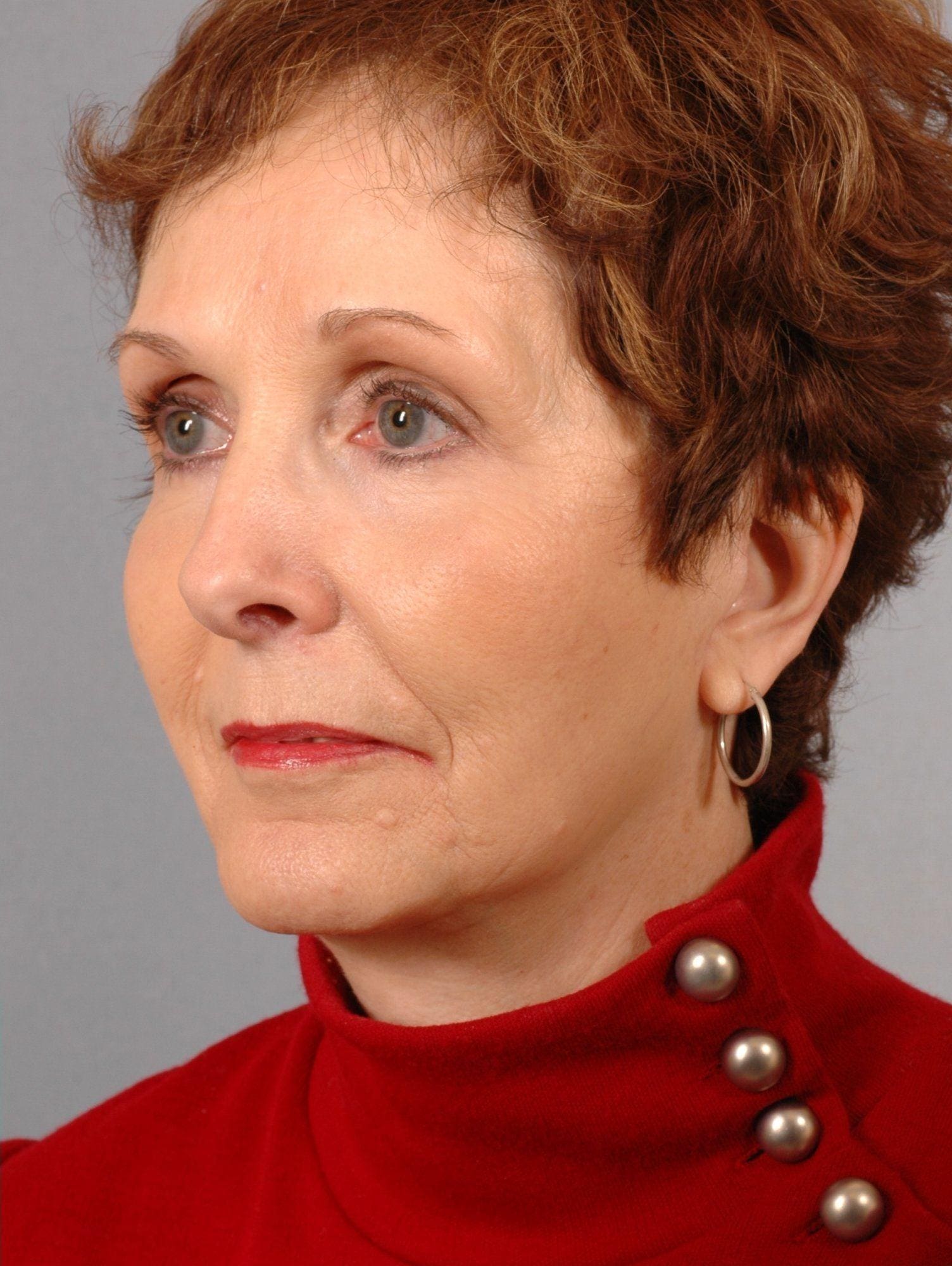 Facelift Patient Photo - Case 15090 - after view-3