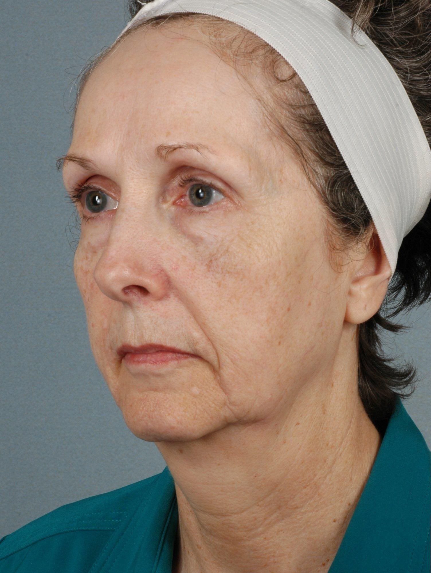 Facelift Patient Photo - Case 15090 - before view-3