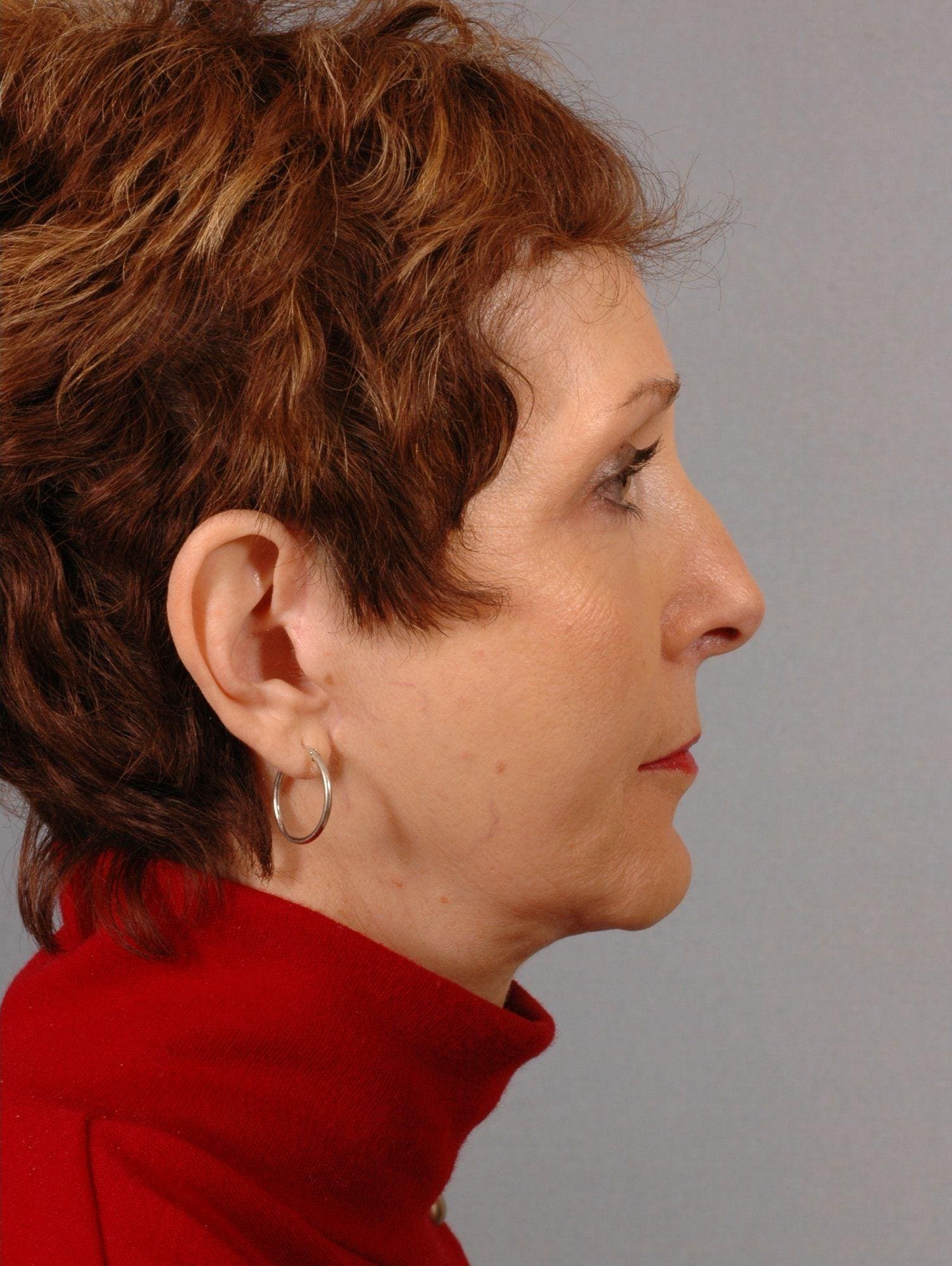 Facelift Patient Photo - Case 15090 - after view-2