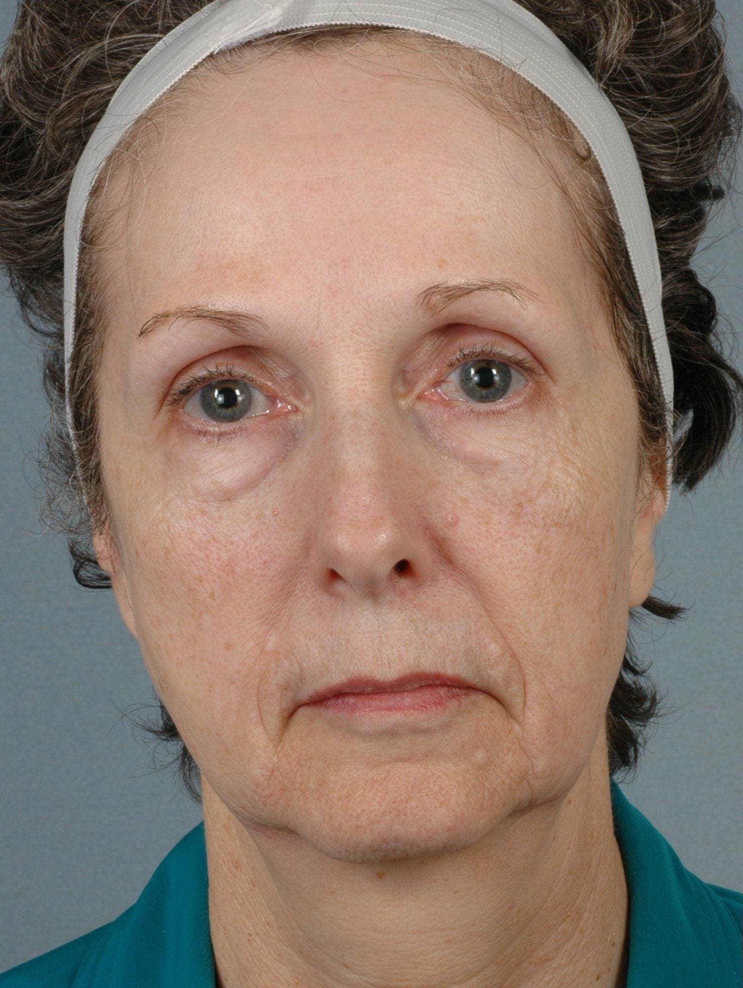 Facelift Patient Photo - Case 15090 - before view-