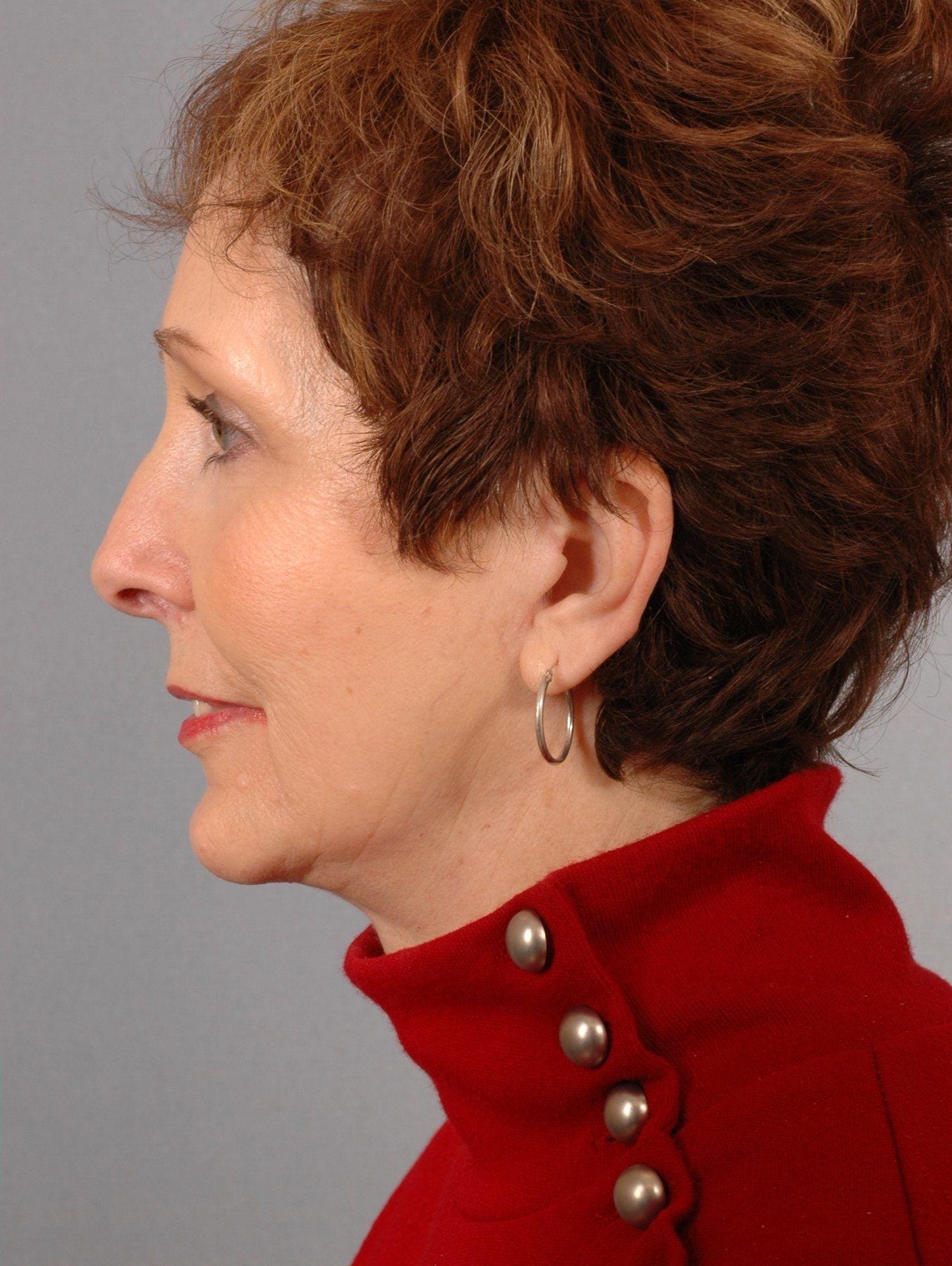 Facelift Patient Photo - Case 15090 - after view-1