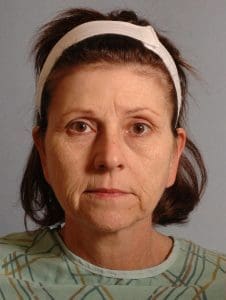 Facelift - Case 15101 - Before