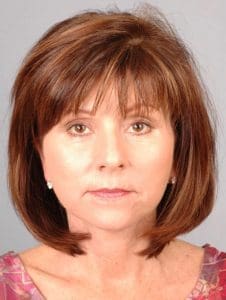 Facelift - Case 15101 - After