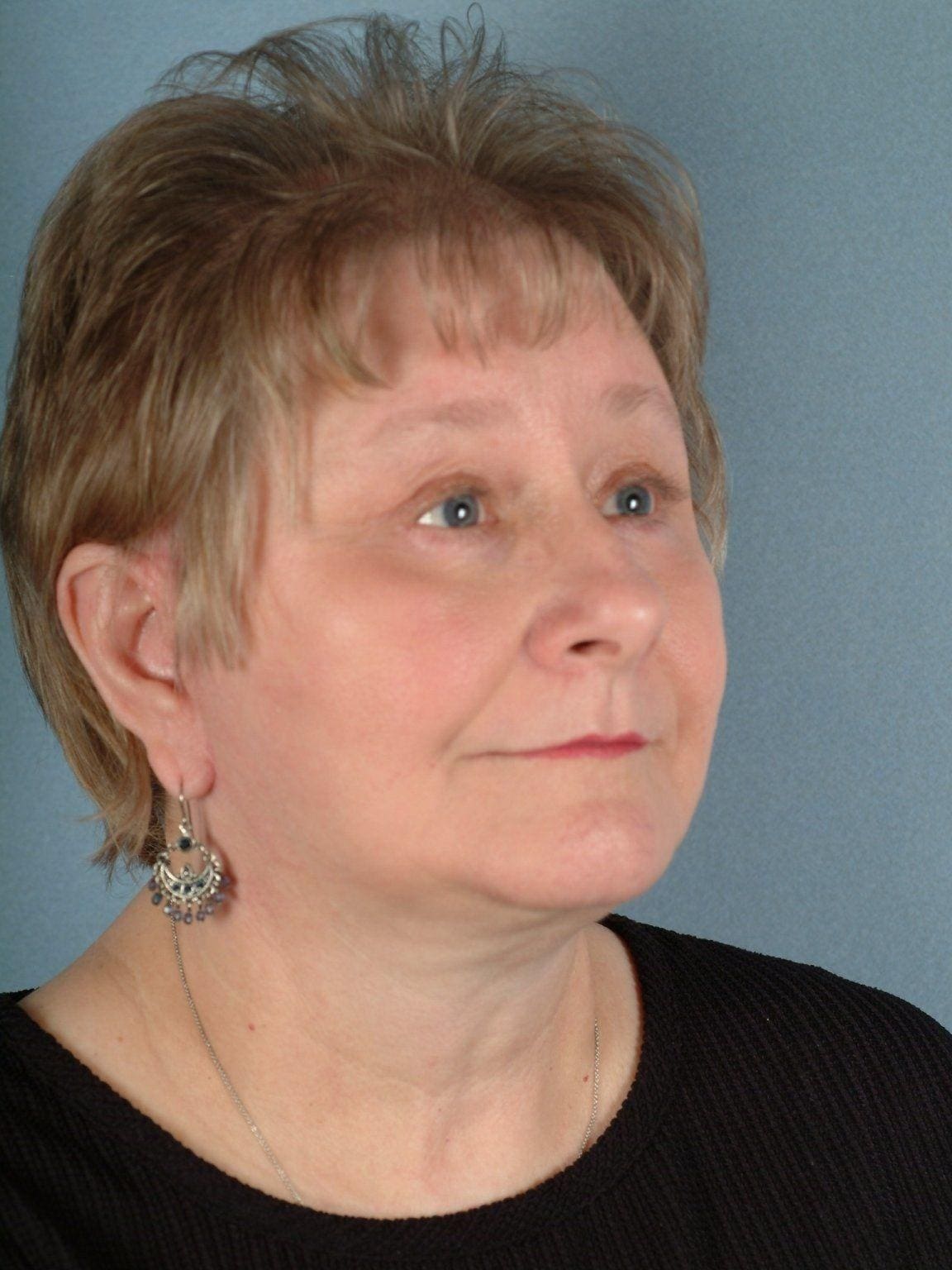 Facelift Patient Photo - Case 15113 - after view-4