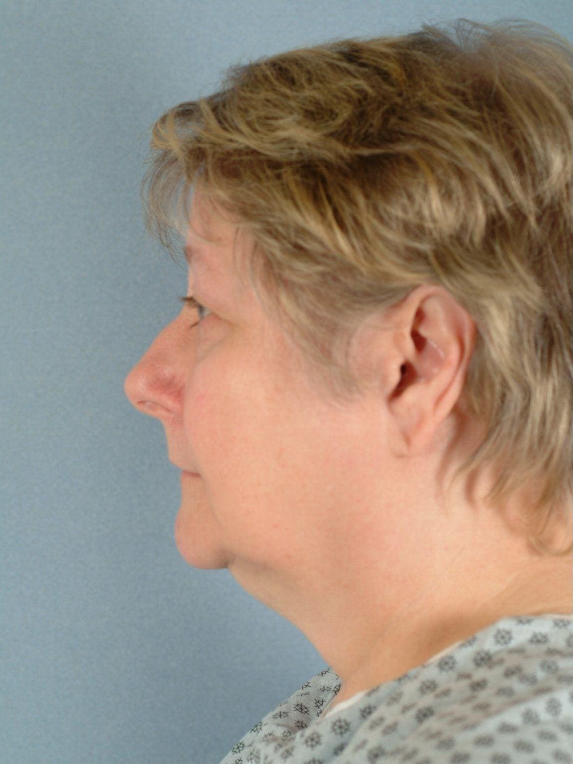 Facelift Patient Photo - Case 15113 - before view-1