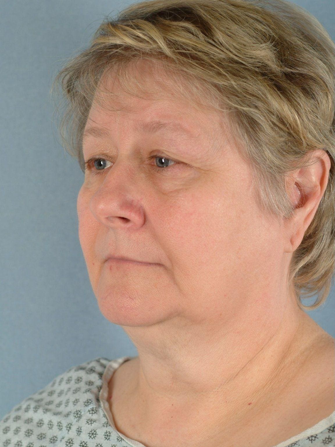 Facelift Patient Photo - Case 15113 - before view-3