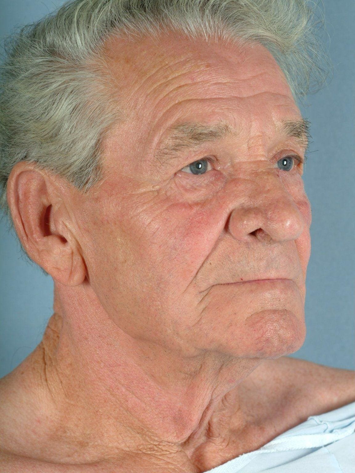 Facelift Patient Photo - Case 15126 - before view-4