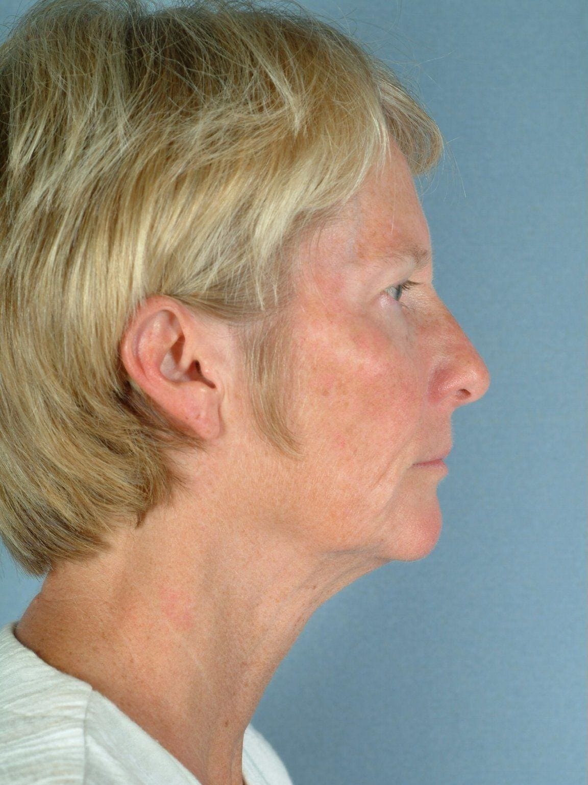 Facelift Patient Photo - Case 15139 - before view-2