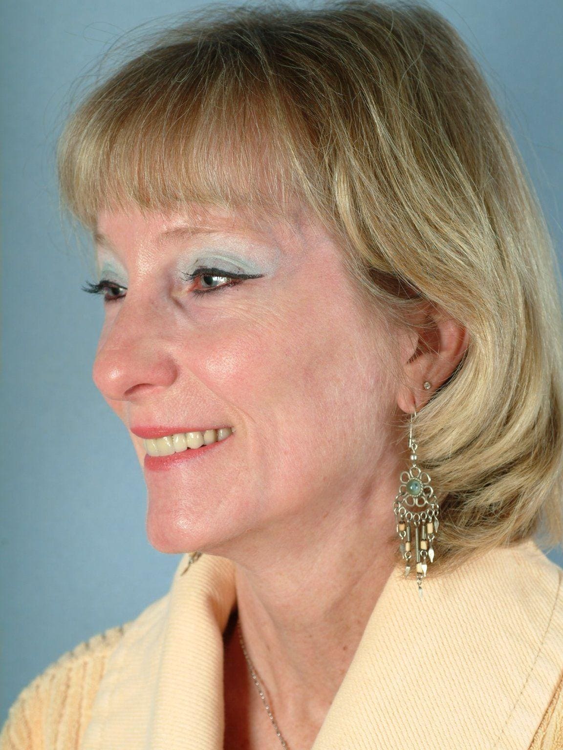 Facelift Patient Photo - Case 15139 - after view-3