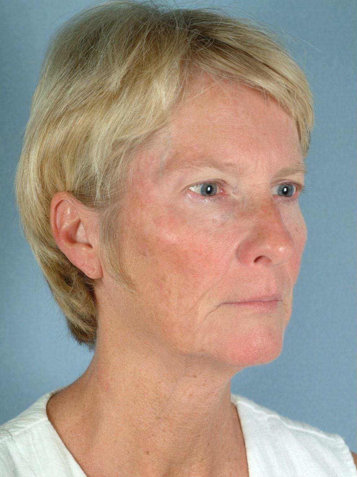 Facelift Patient Photo - Case 15139 - before view-4