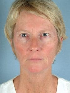 Facelift - Case 15139 - Before