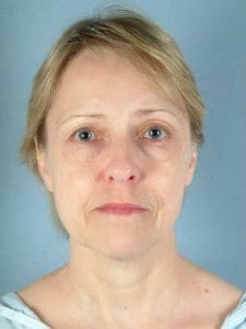 Facelift - Case 15151 - Before