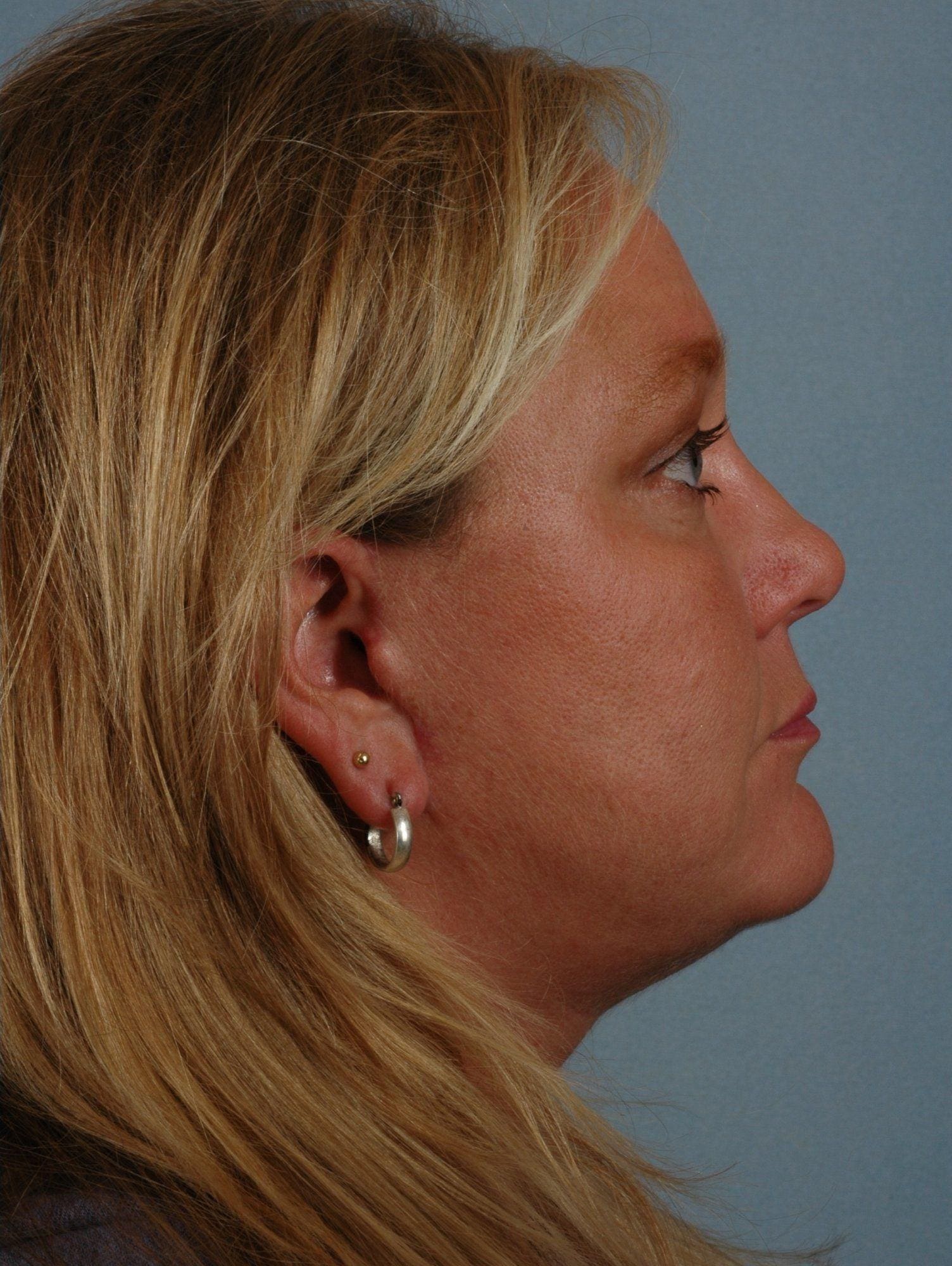 Facelift Patient Photo - Case 15164 - after view-1