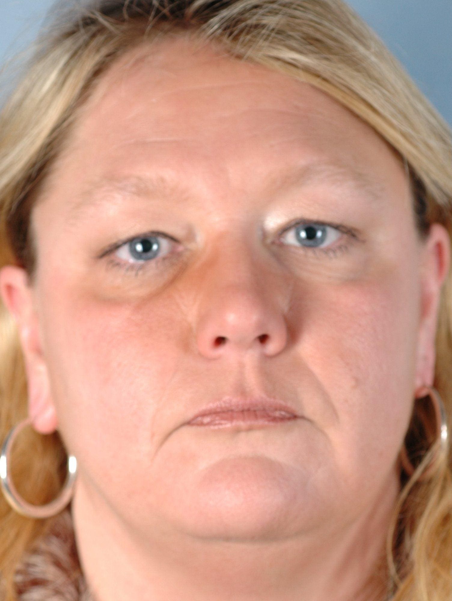 Facelift Patient Photo - Case 15164 - before view-